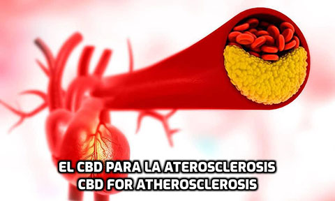 En este momento estás viendo El CBD para la Aterosclerosis
