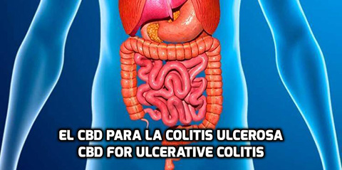 Lee más sobre el artículo El CBD para la Colitis Ulcerosa