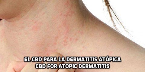 Lee más sobre el artículo El CBD para la Dermatitis Atópica