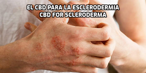 Lee más sobre el artículo El CBD para la Esclerodermia