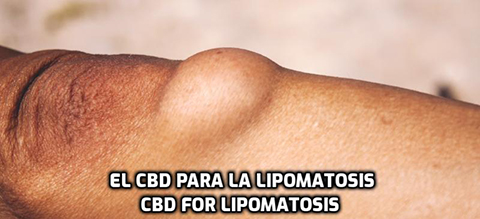 Lee más sobre el artículo El CBD para la Lipomatosis