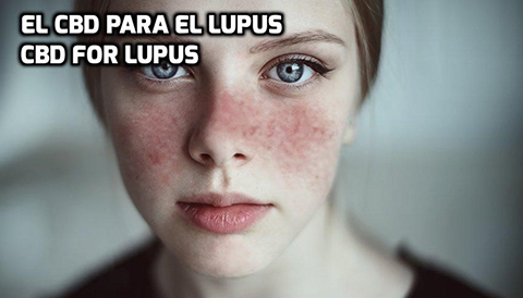 En este momento estás viendo El CBD para el Lupus