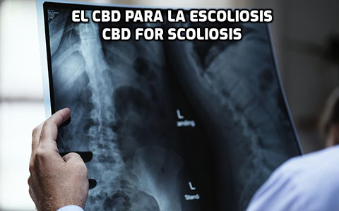 Lee más sobre el artículo El CBD para la Escoliosis